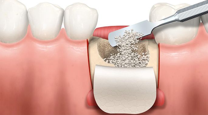 Ghép xương Implant