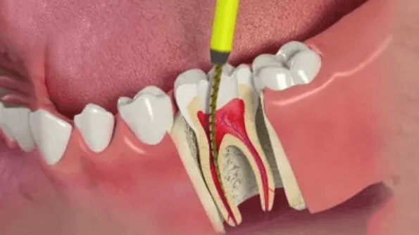 Điều trị tủy răng nhiều chân