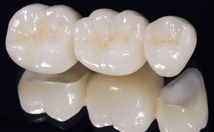 Cầu răng sứ 3 đơn vị