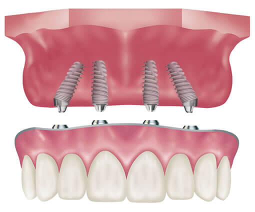 Phục hình răng trên Implant