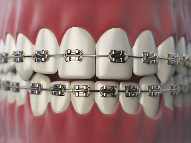 Niềng răng mắc cài kim loại
